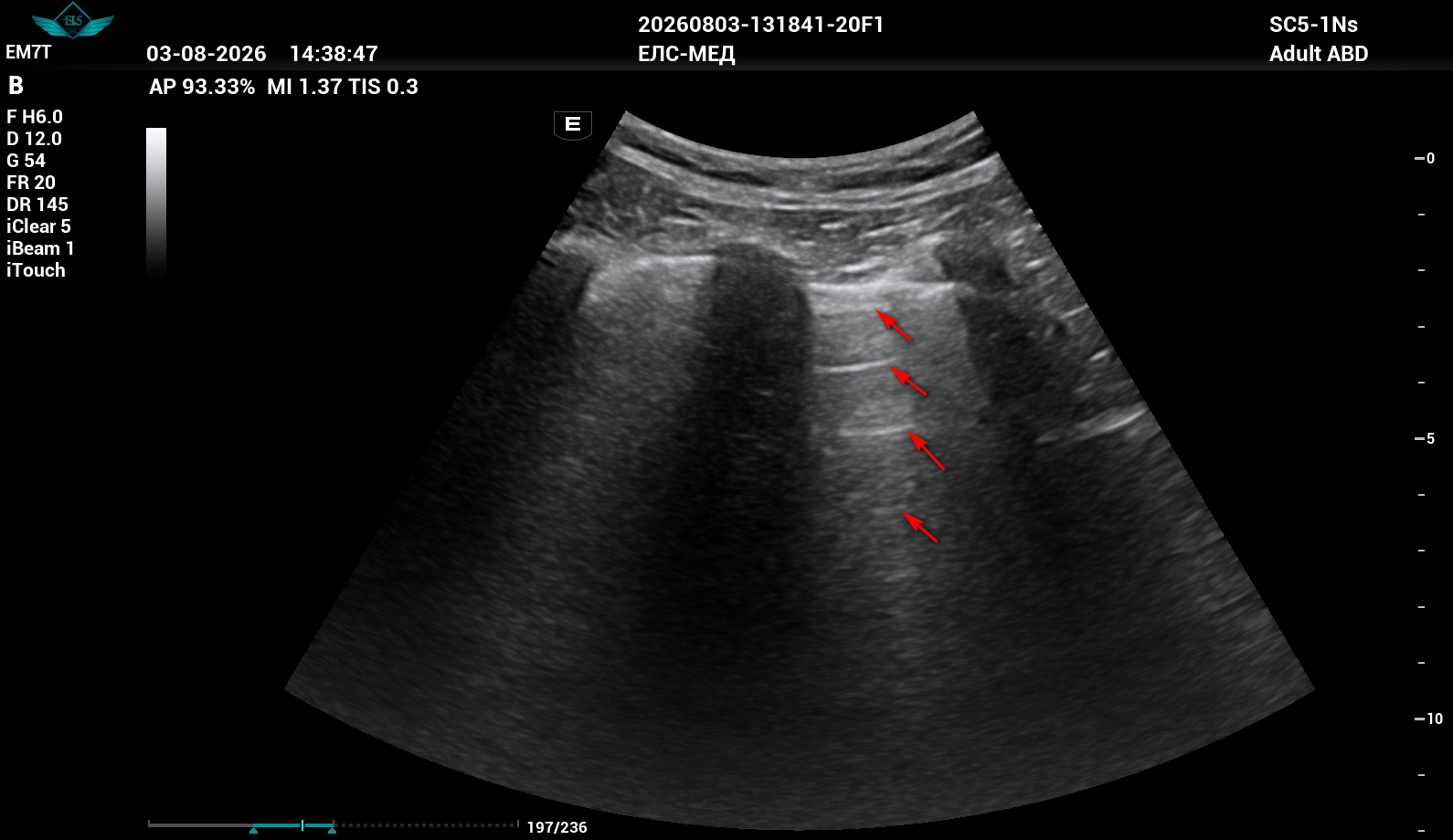 Ультразвуковое исследование лёгких: возможности, показания и особенности метода.